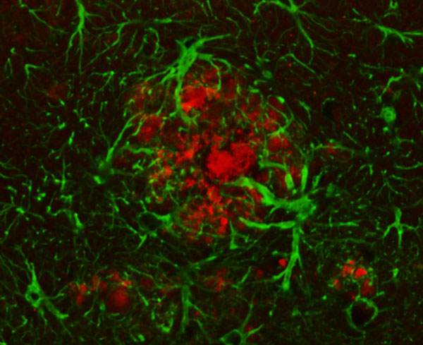 “Nos interesa el rol de la neuroinflamación en el proceso neurodegenerativo del cerebro. Tenemos indicios claros de que, en este proceso, los astrocitos (imagen)  y las células de la microglía son afectados en forma temprana", explican los investigadores.