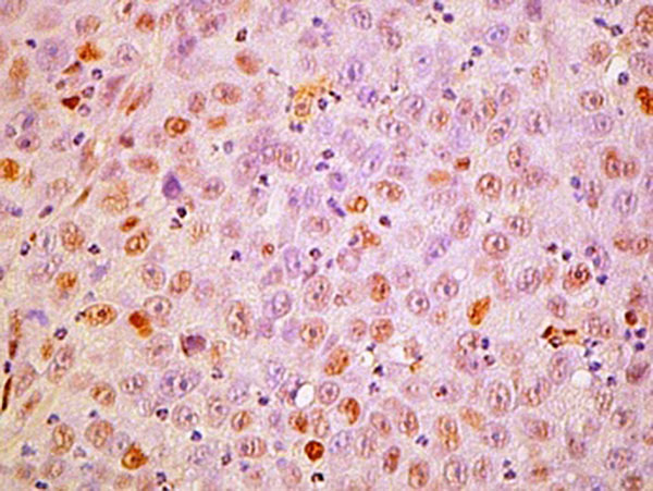 Imagen microscópica de células tumorales tratadas con dos drogas, una activadora de hemo oxigenasa y otra de GR.